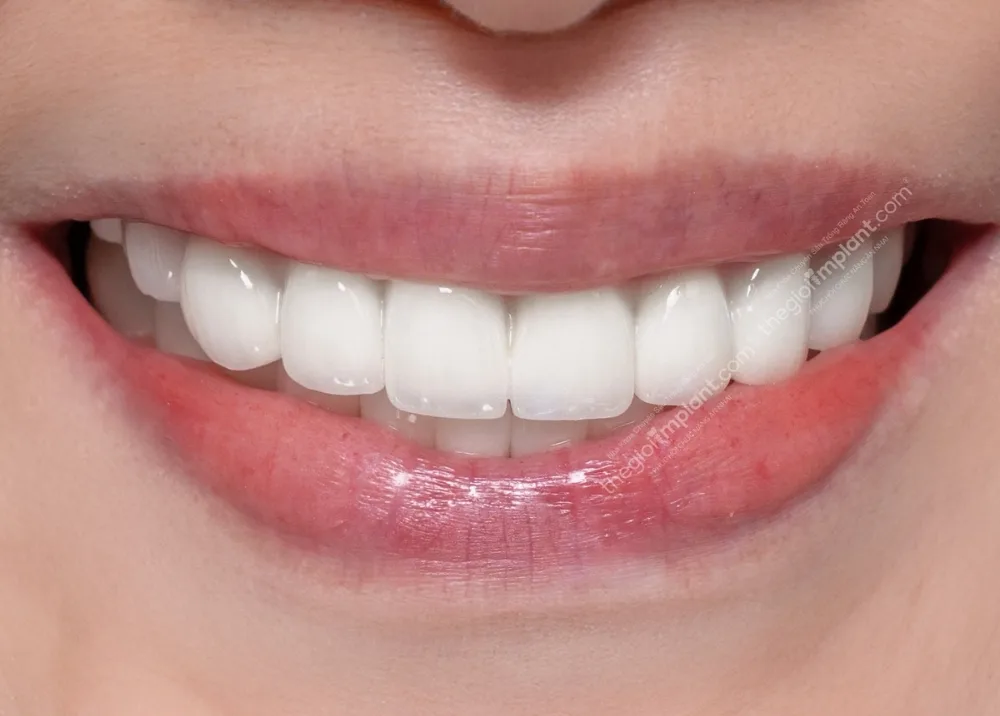 răng implant dentium - hình 5
