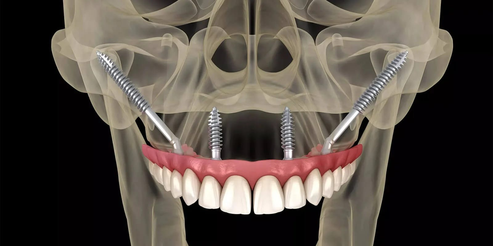 tiêu xương hàm - hình 3