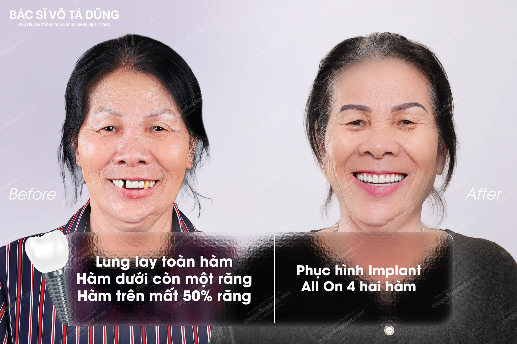 trồng implant trả góp - hình 2