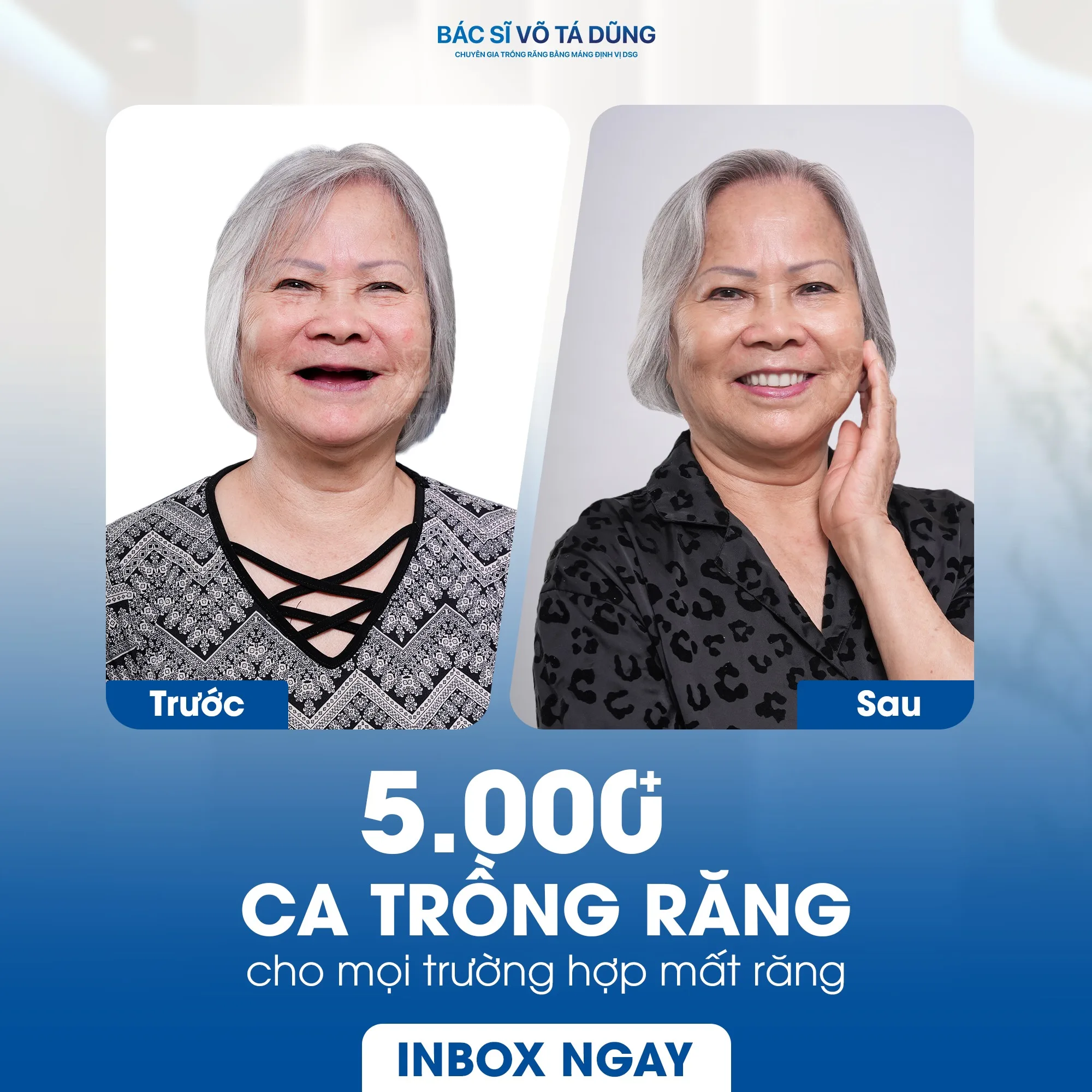 trồng implant trả góp - hình 4