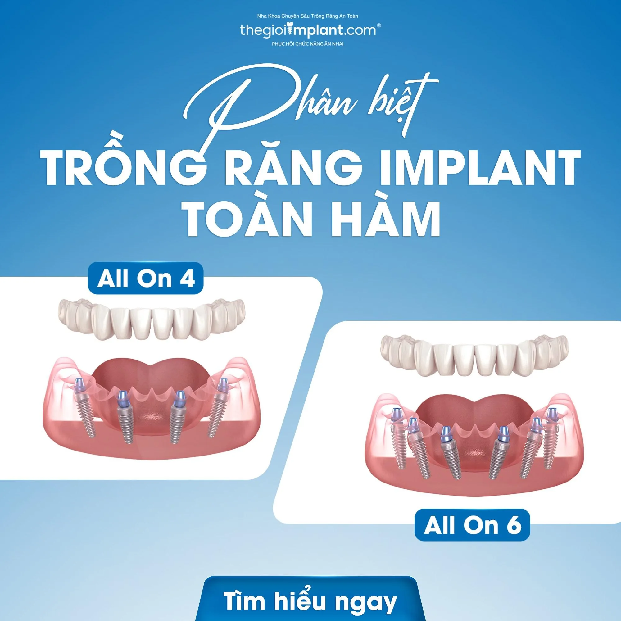 trồng răng implant tphcm - hình 2