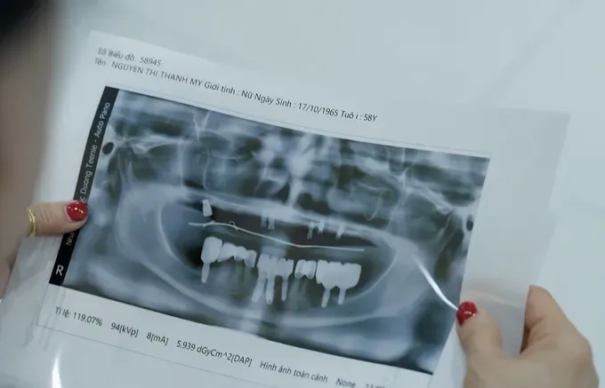 trồng răng implant tphcm - hình 5