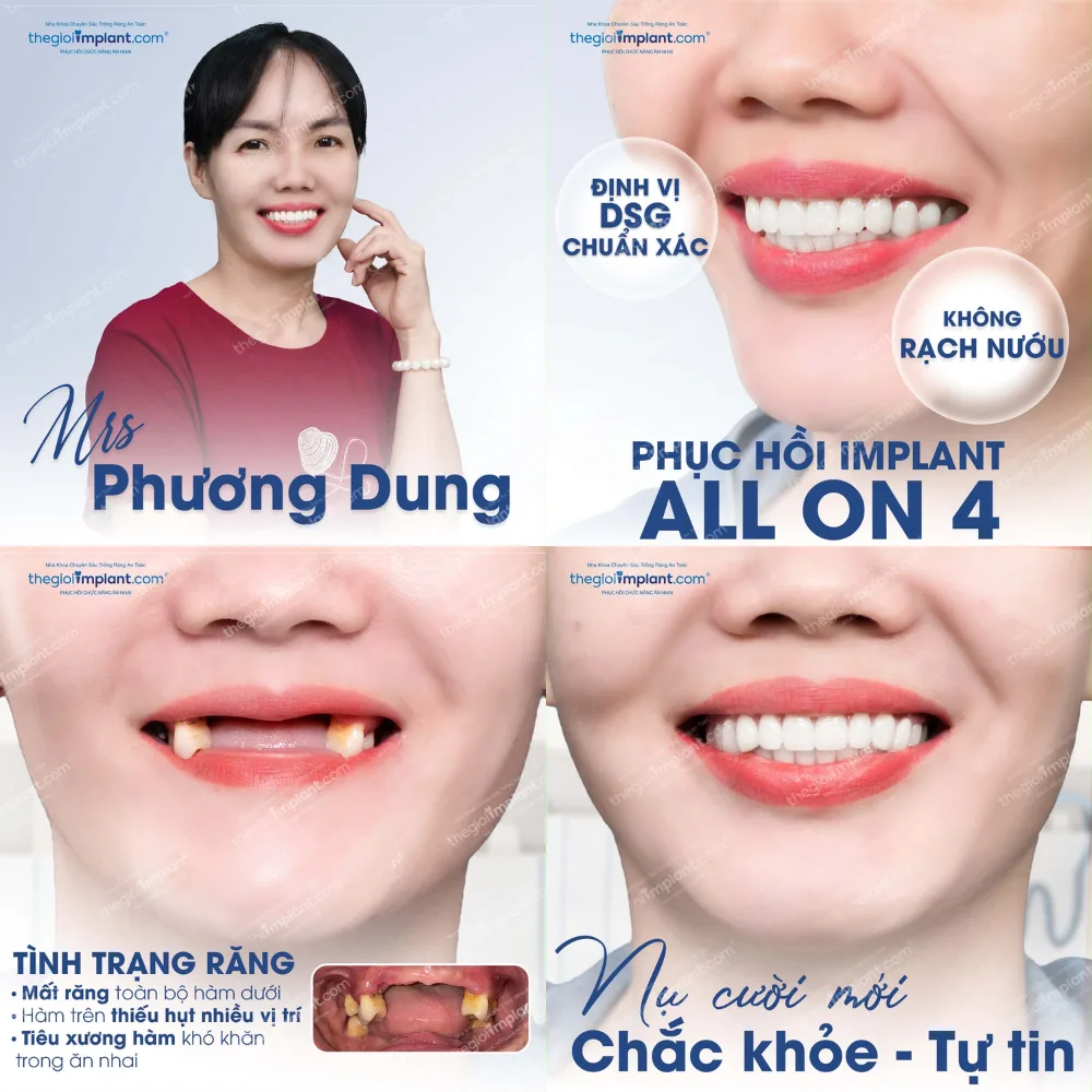 implant all on 4 tphcm - hình 2