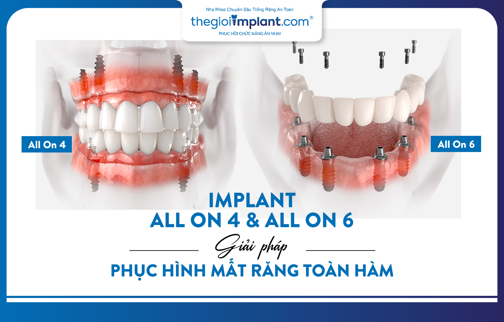Implant All-on-6 khác All-on-4 thế nào 2026