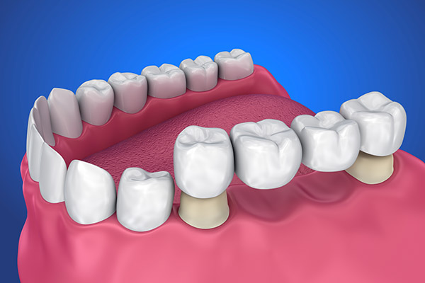 Implant mất nhiều răng liền kề 2026