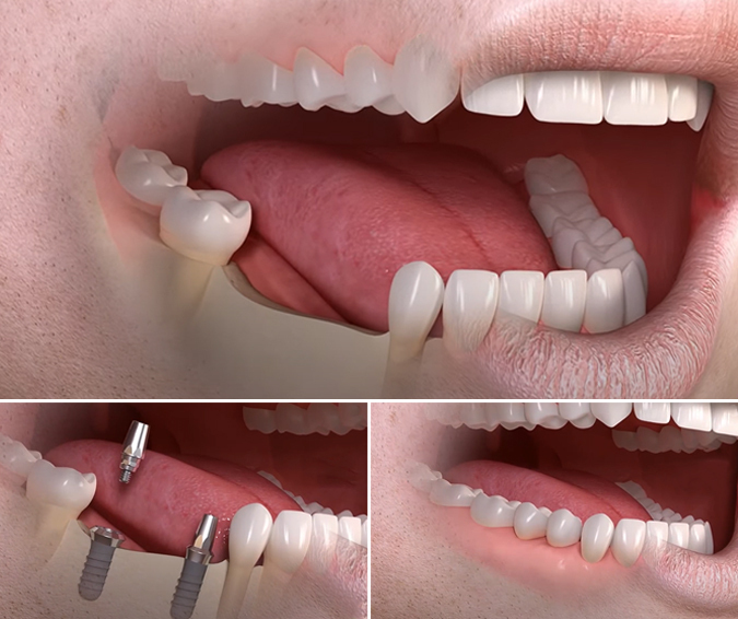 implant mất nhiều răng - hình 2