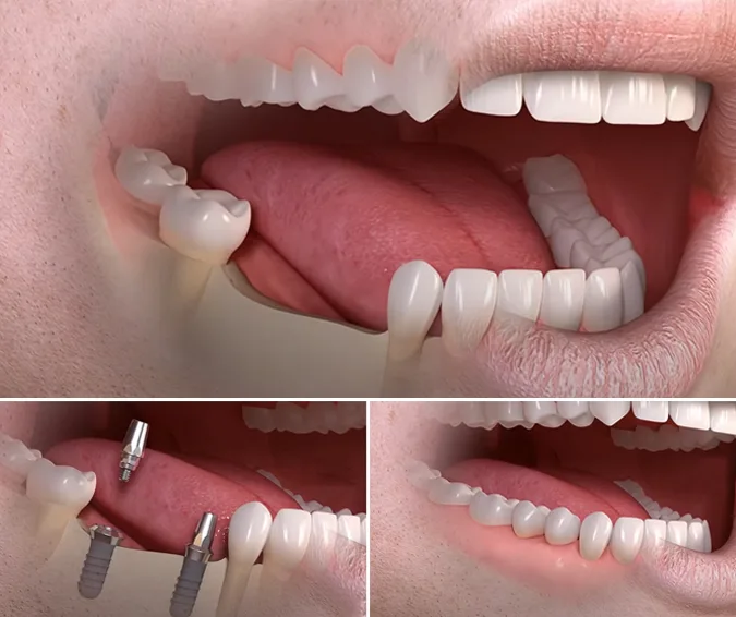 implant mất nhiều răng - hình 2