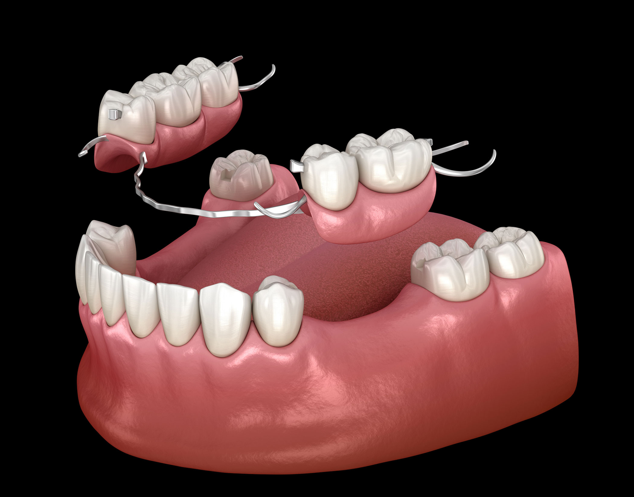 implant mất nhiều răng - hình 3