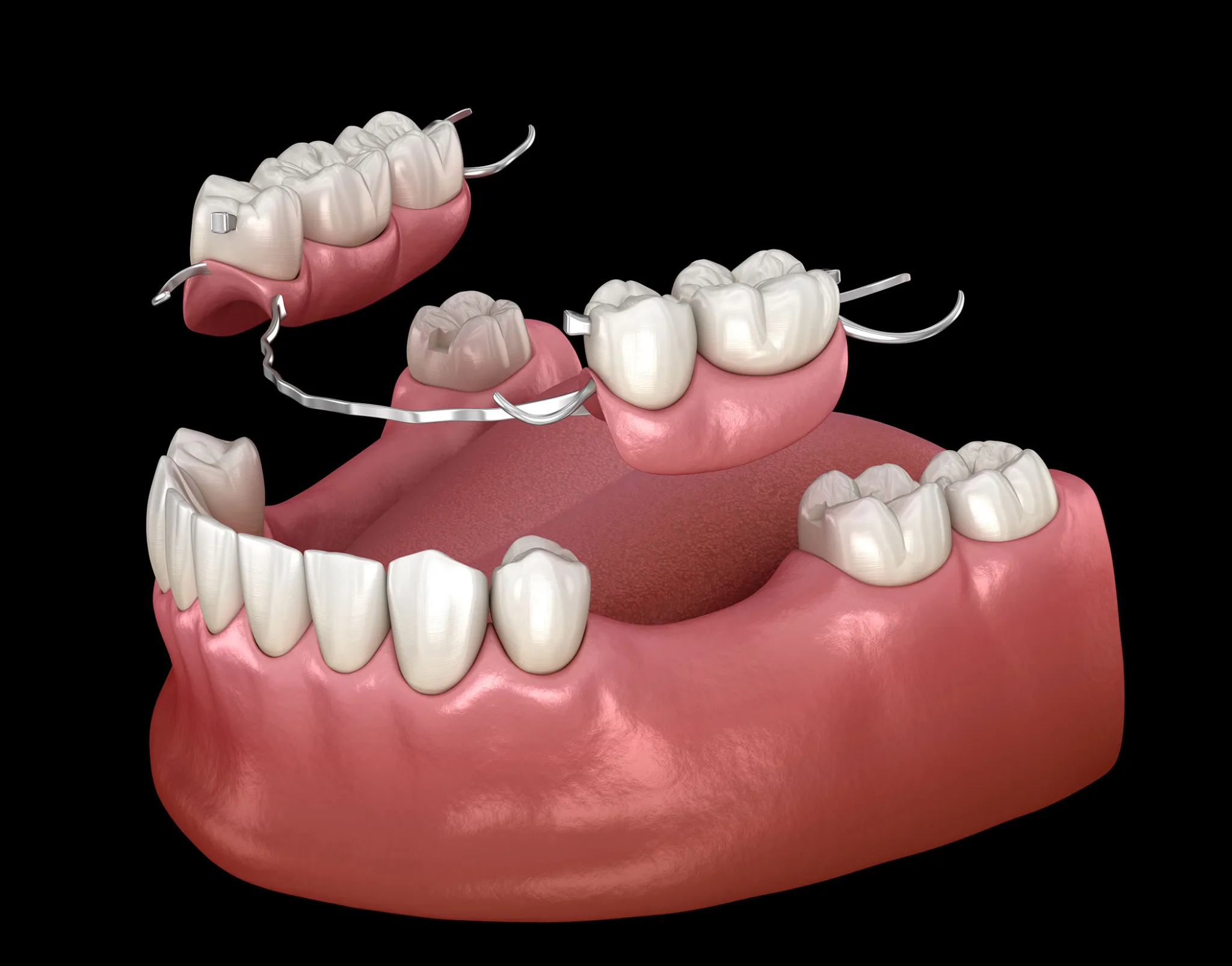 implant mất nhiều răng - hình 3
