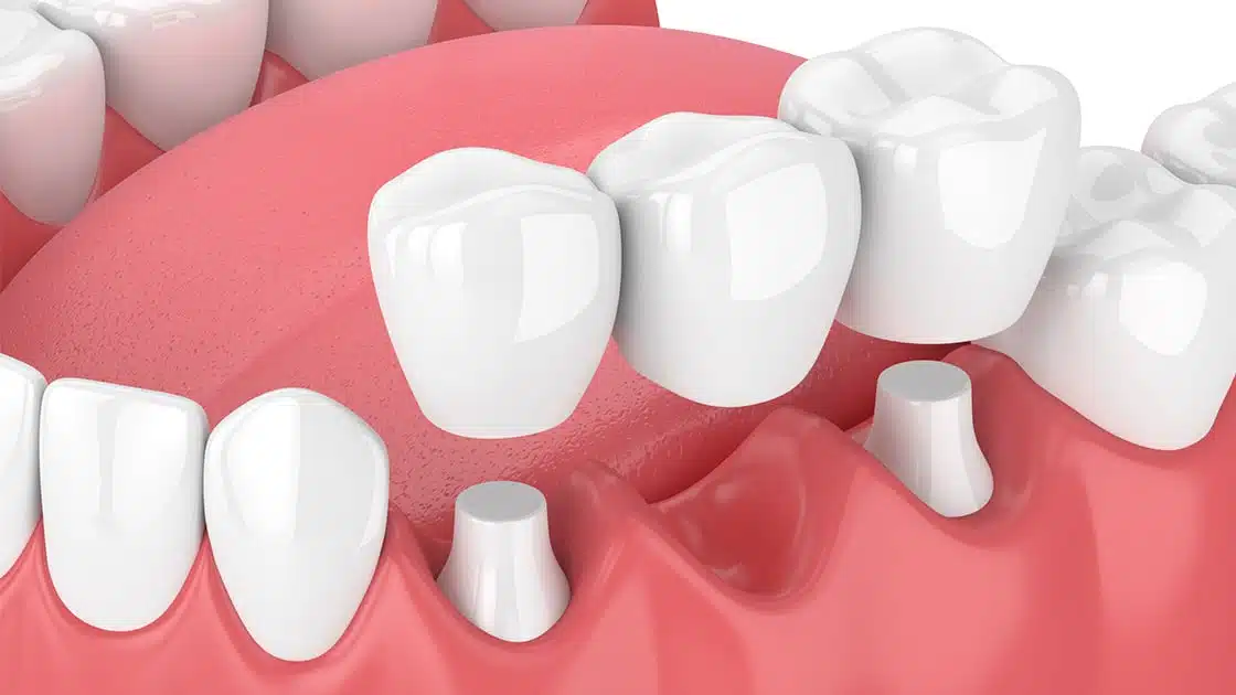 implant mất nhiều răng - hình 4