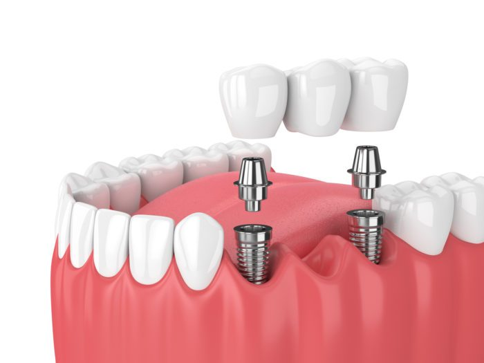 implant mất nhiều răng - hình 5