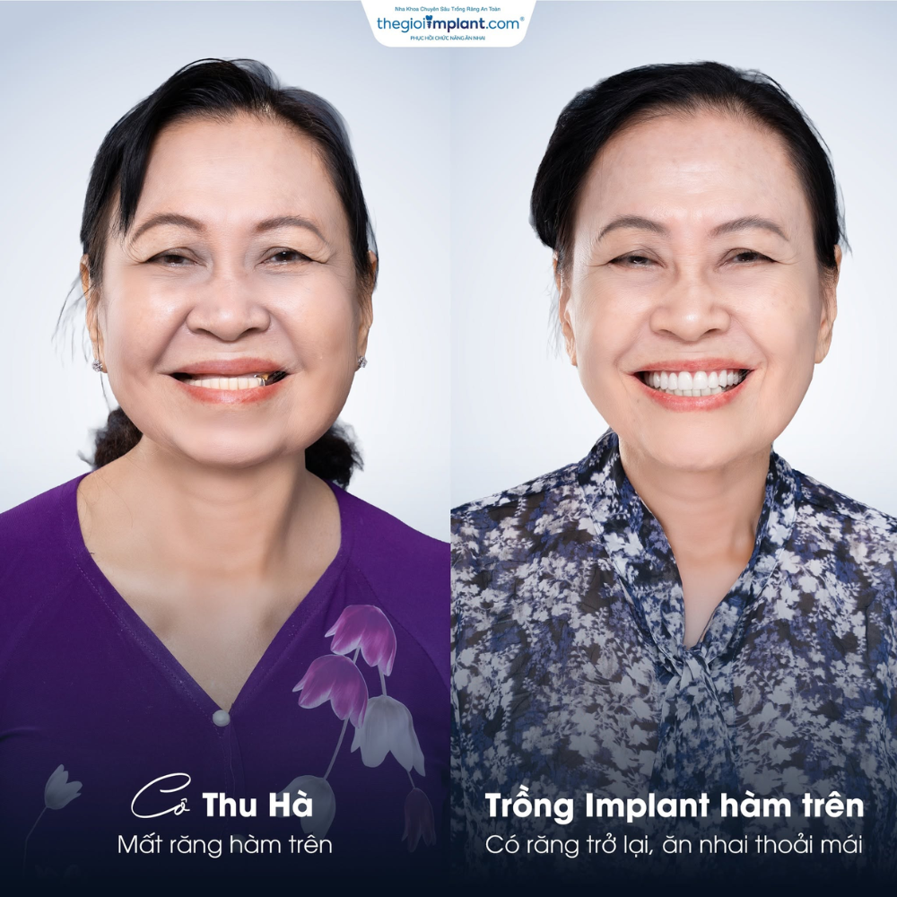 Implant cho người lớn tuổi TPHCM 2026