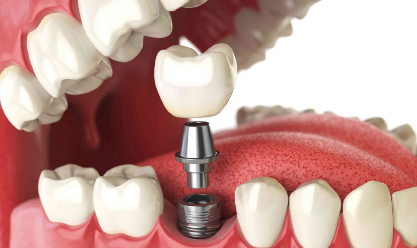 implant tức thì - hình 2