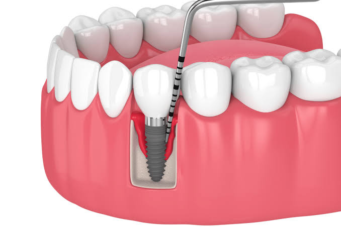 implant tức thì - hình 3