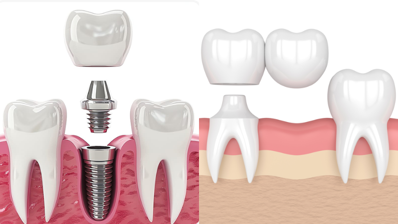 Trồng răng Implant vs cầu răng: chọn nào 2026