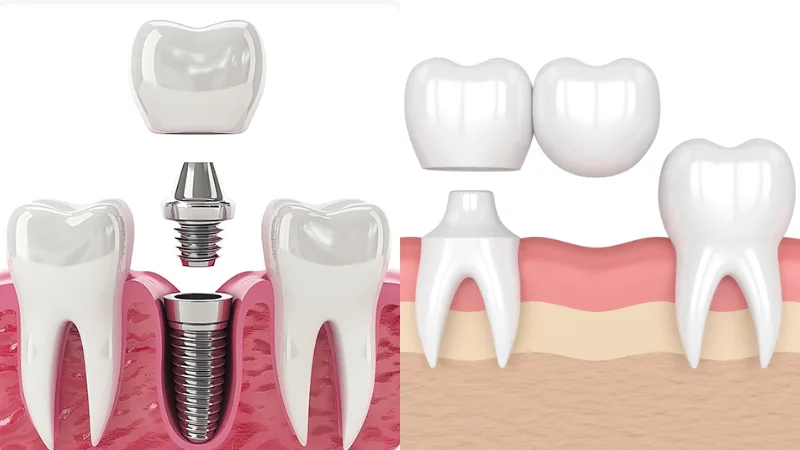 Implant vs cầu răng sứ: khác nhau thế nào, nên chọn gì 2026