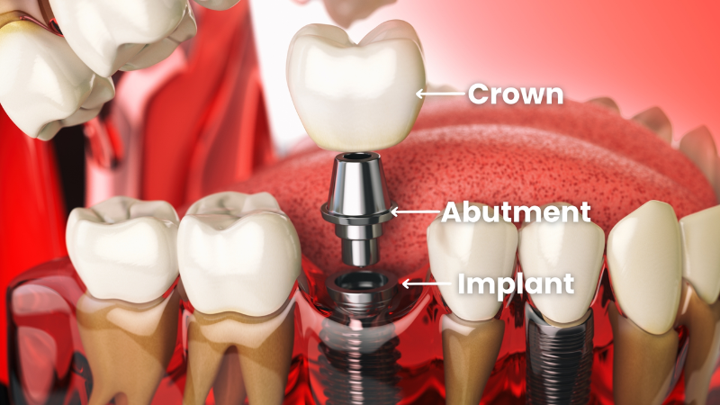 implant vs cầu răng - hình 2