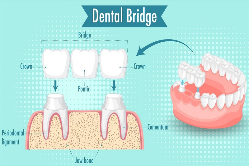 implant vs cầu răng - hình 3