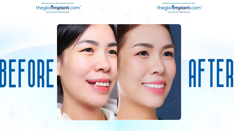 implant vs cầu răng - hình 4