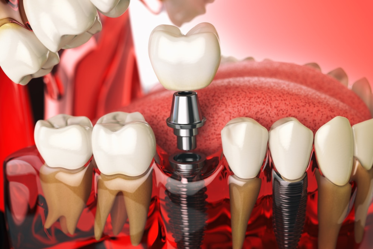 kiêng gì sau cấy implant