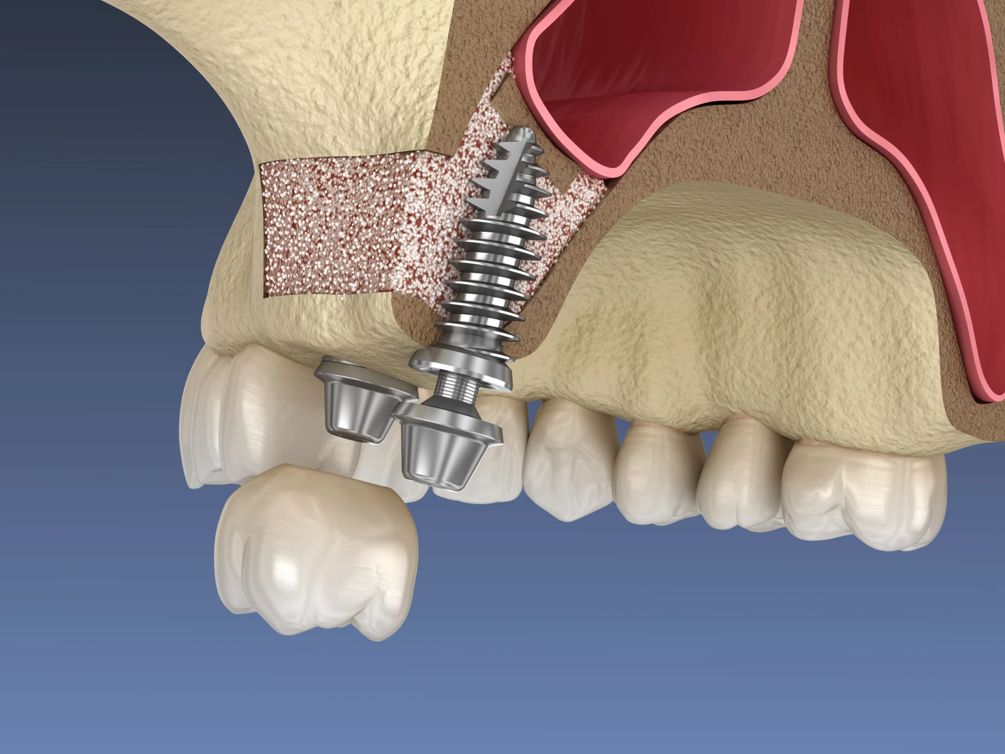 Nâng xoang Implant: 2 kỹ thuật kín hở 2026