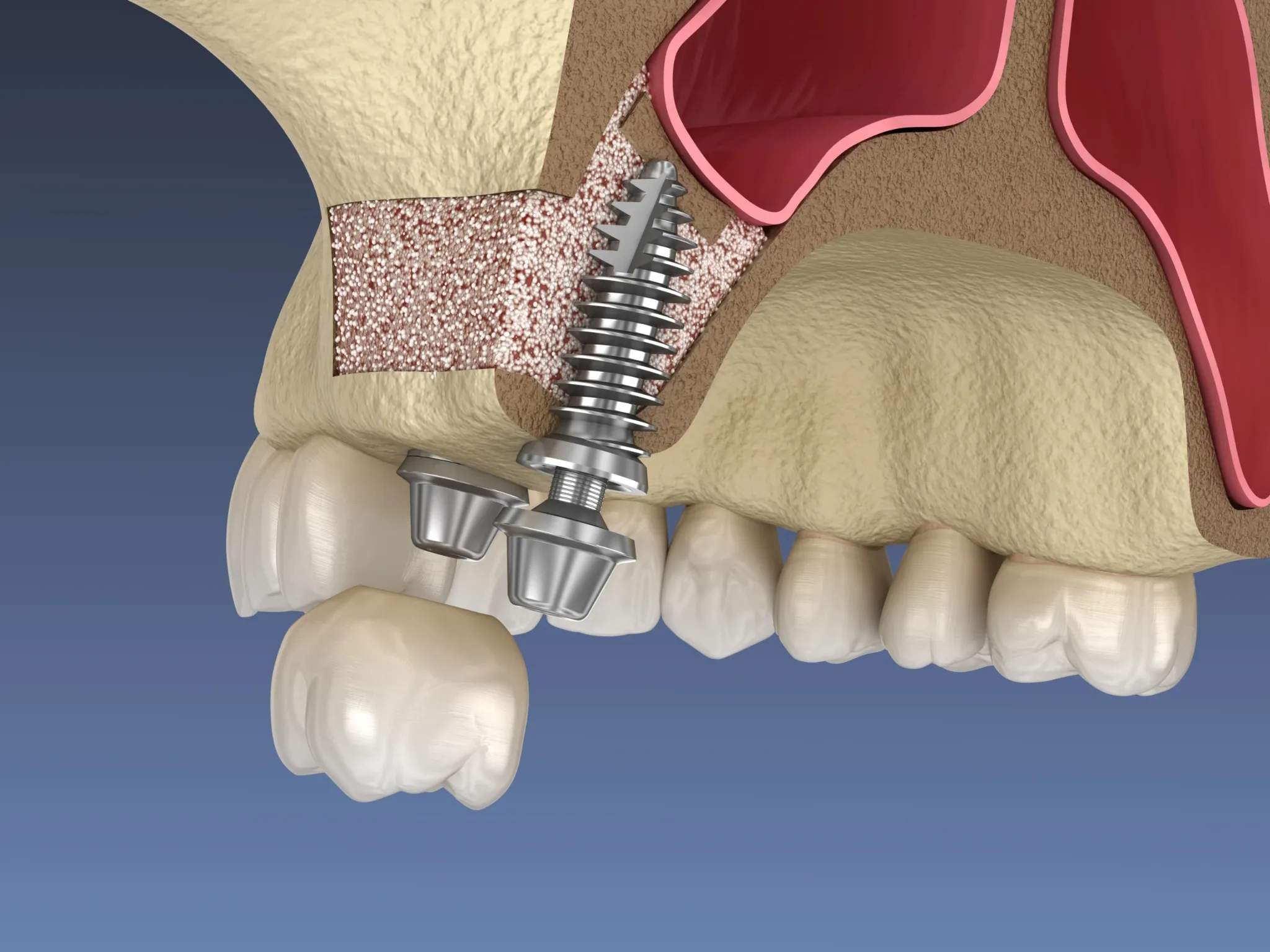 Nâng xoang Implant: Kỹ thuật kín, hở, quy trình và chi phí 2026