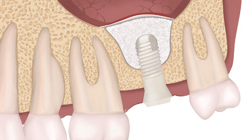 nâng xoang implant - hình 2