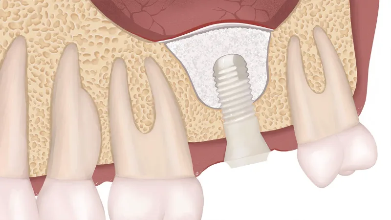 Thời điểm cấy trụ Implant sau nâng xoang phụ thuộc lượng xương