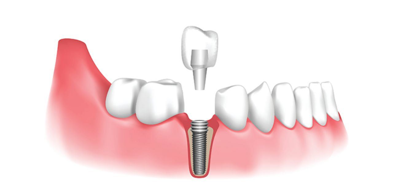 Răng sứ trên Implant: Titan và toàn sứ khác nhau thế nào 2026
