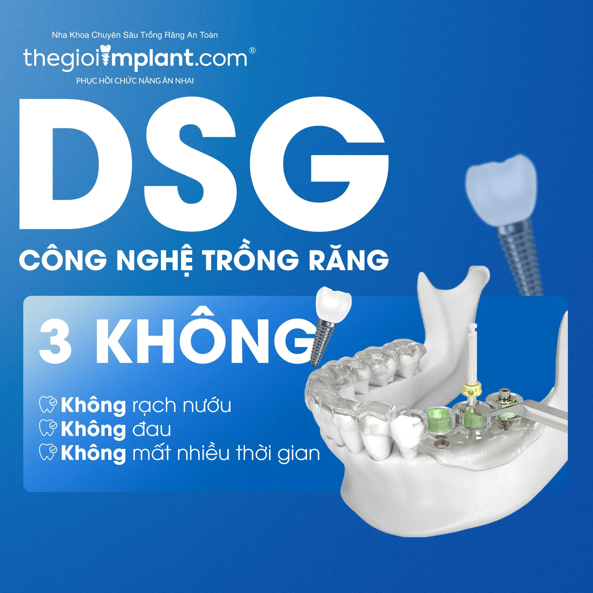 Máng định vị DSG đặt trụ đúng vị trí cho phục hình răng sứ trên Implant