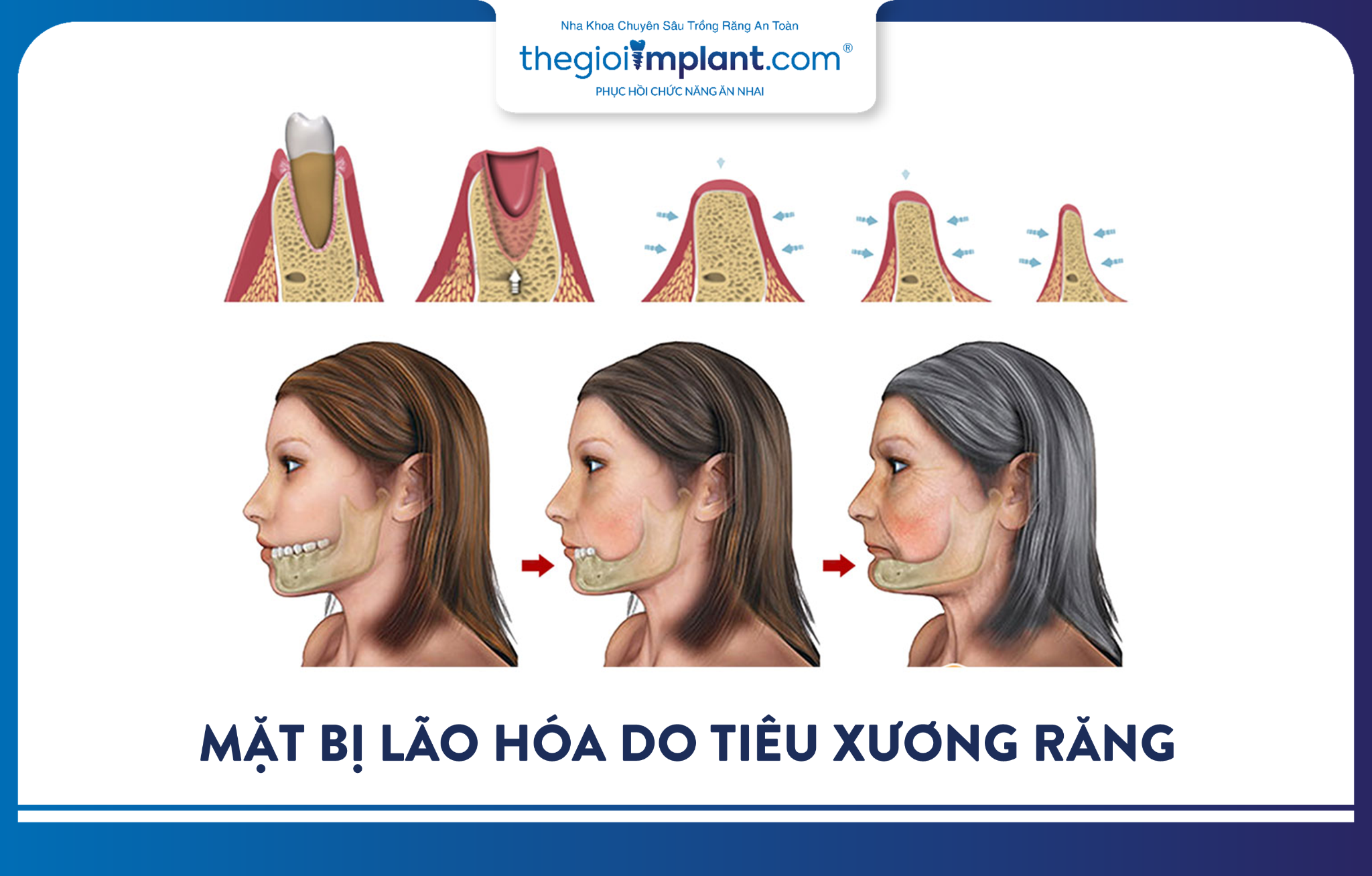 tiêu xương hàm hậu quả - hình 3