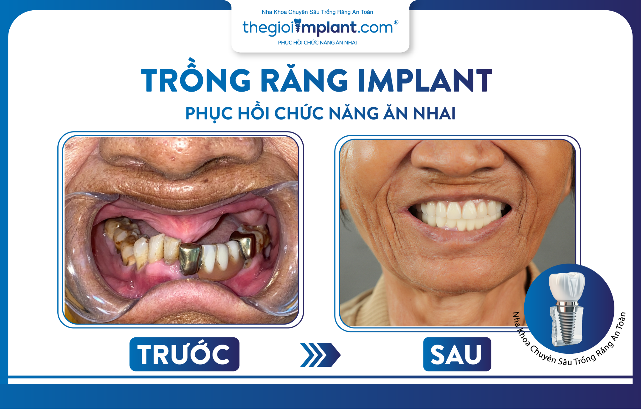 tiêu xương hàm hậu quả - hình 5