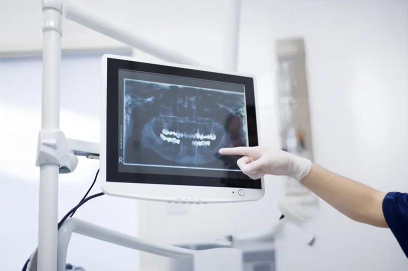 tư vấn implant miễn phí - hình 2