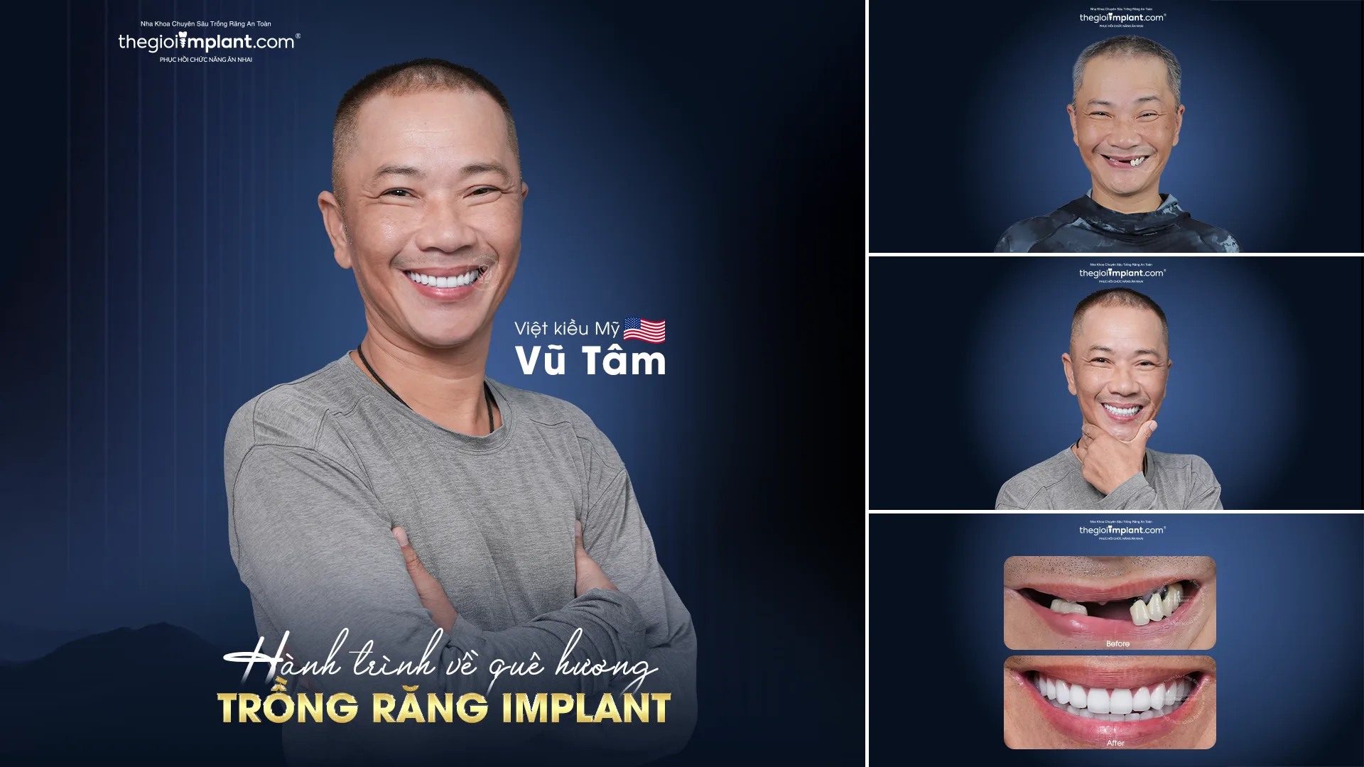 Trồng răng Implant Việt Kiều: quy trình 2026