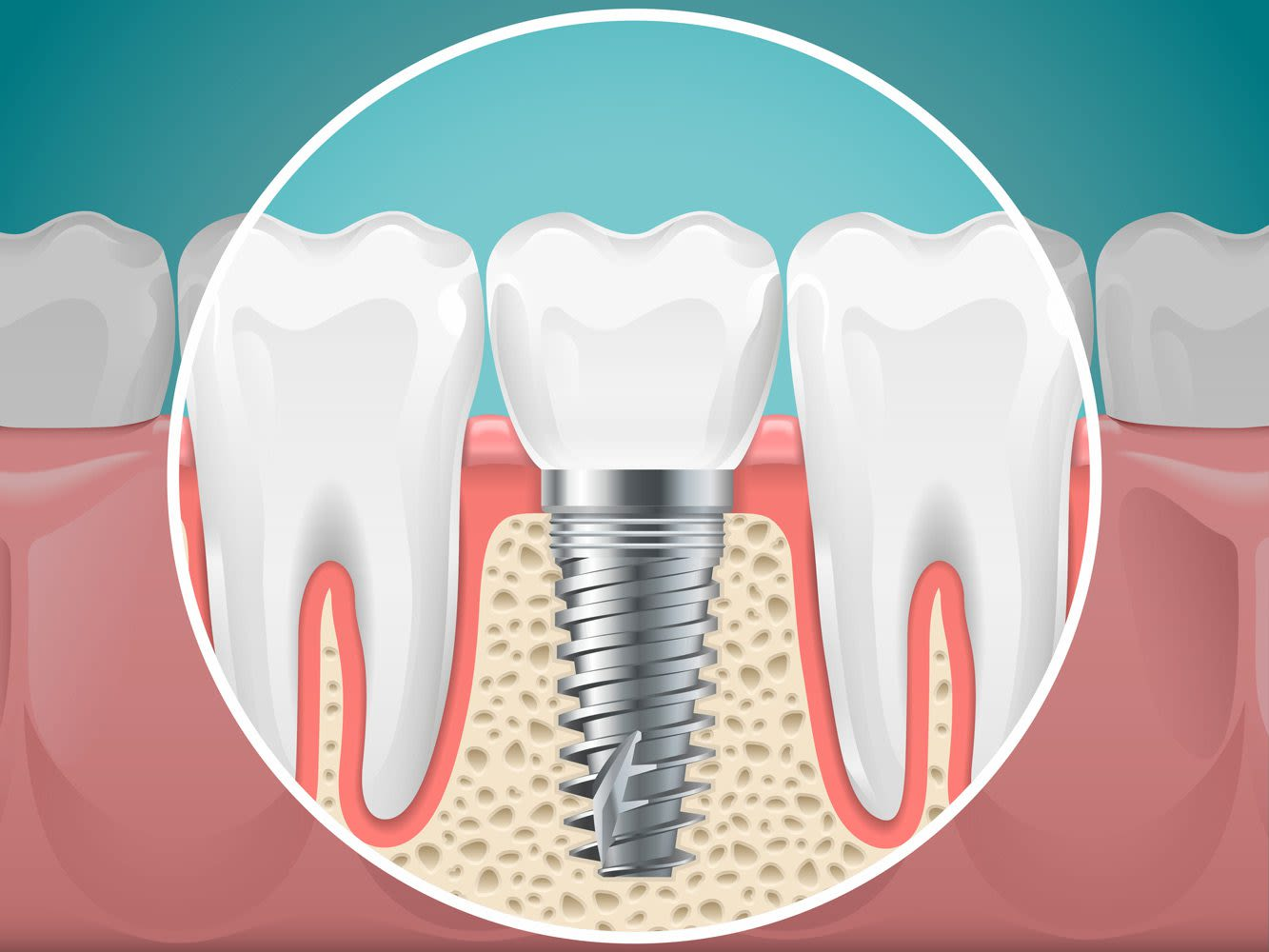 Cấy Implant hàm dưới: thuận lợi hơn 2026