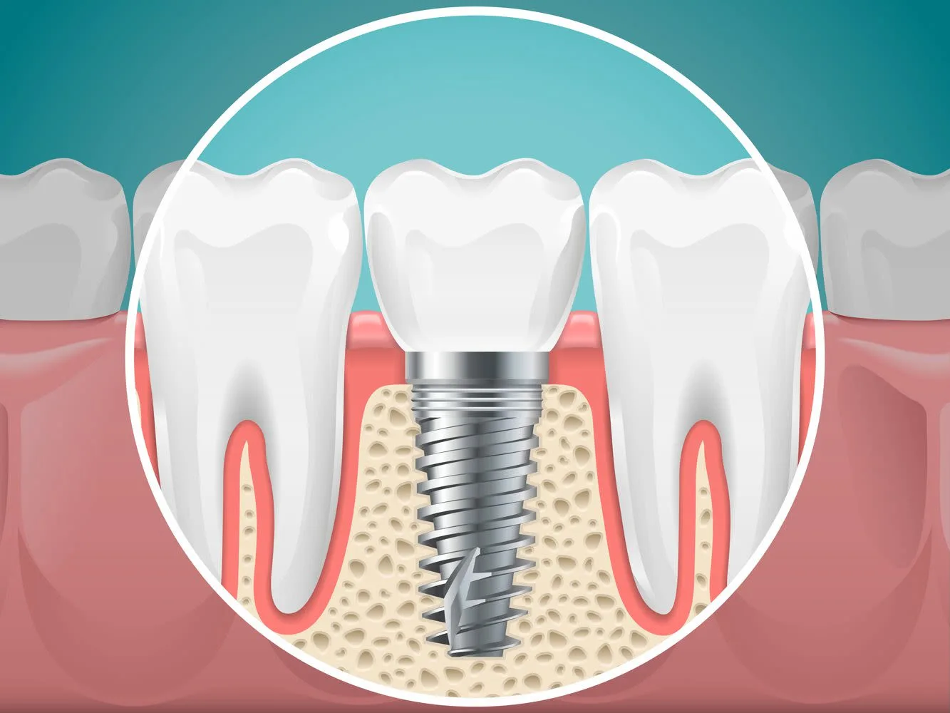 Cấy Implant hàm dưới: thuận lợi hơn 2026