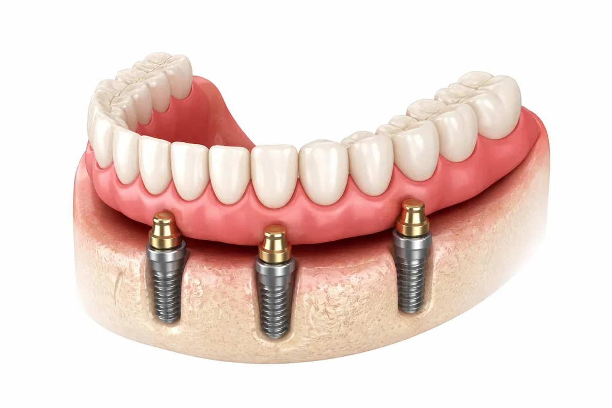 cấy implant hàm dưới - hình 2