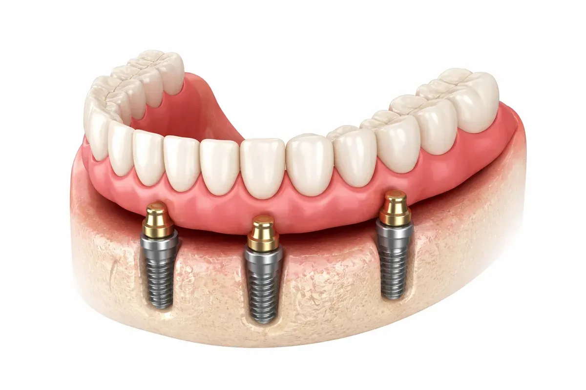 cấy implant hàm dưới - hình 2