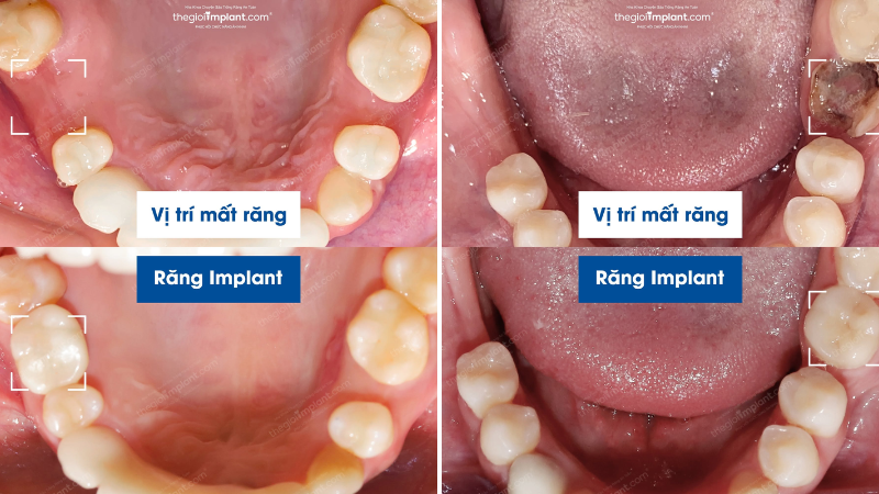 cấy implant hàm dưới - hình 5