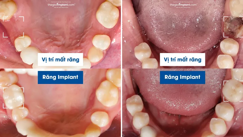 cấy implant hàm dưới - hình 5