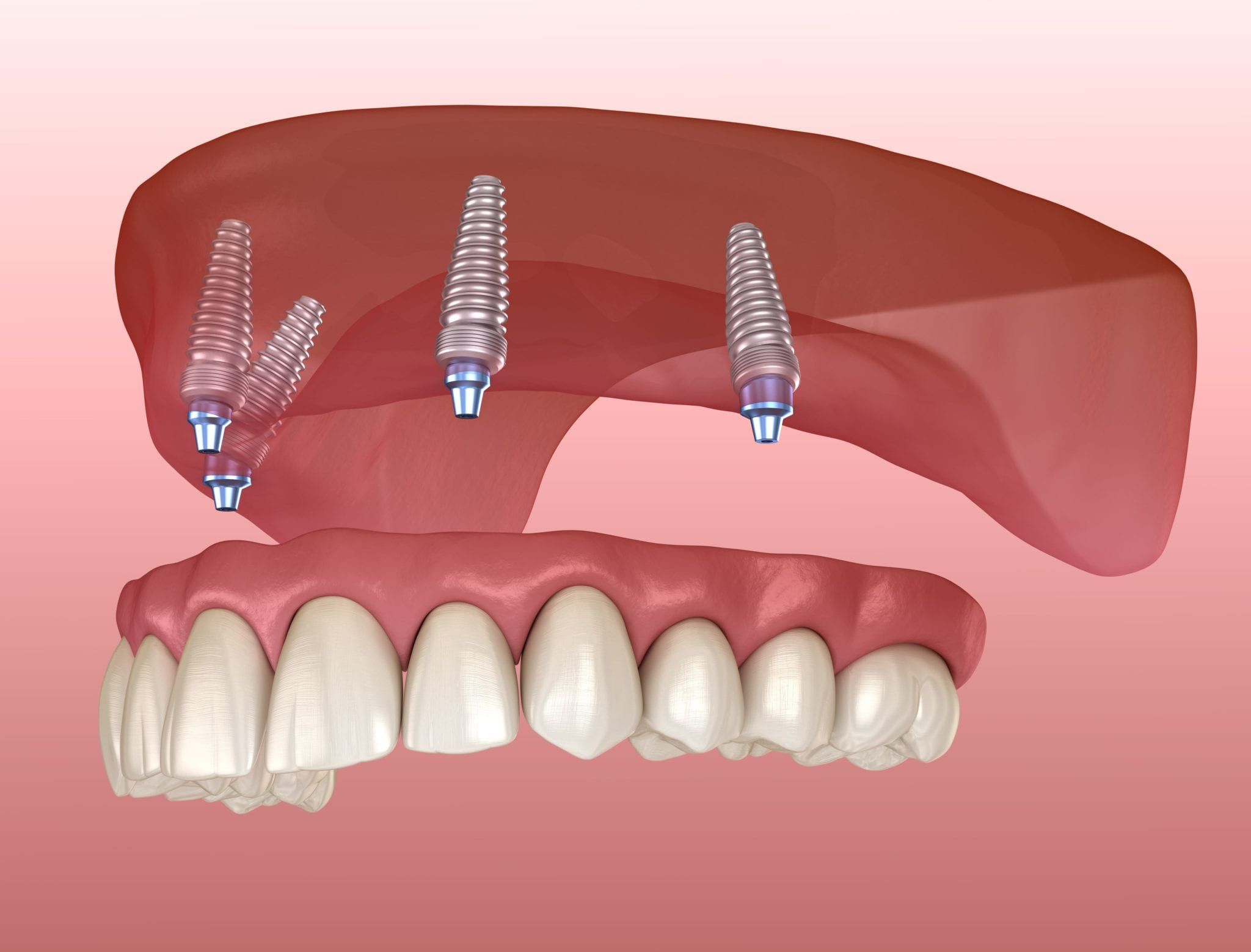 Cấy Implant hàm trên: kỹ thuật & lưu ý 2026