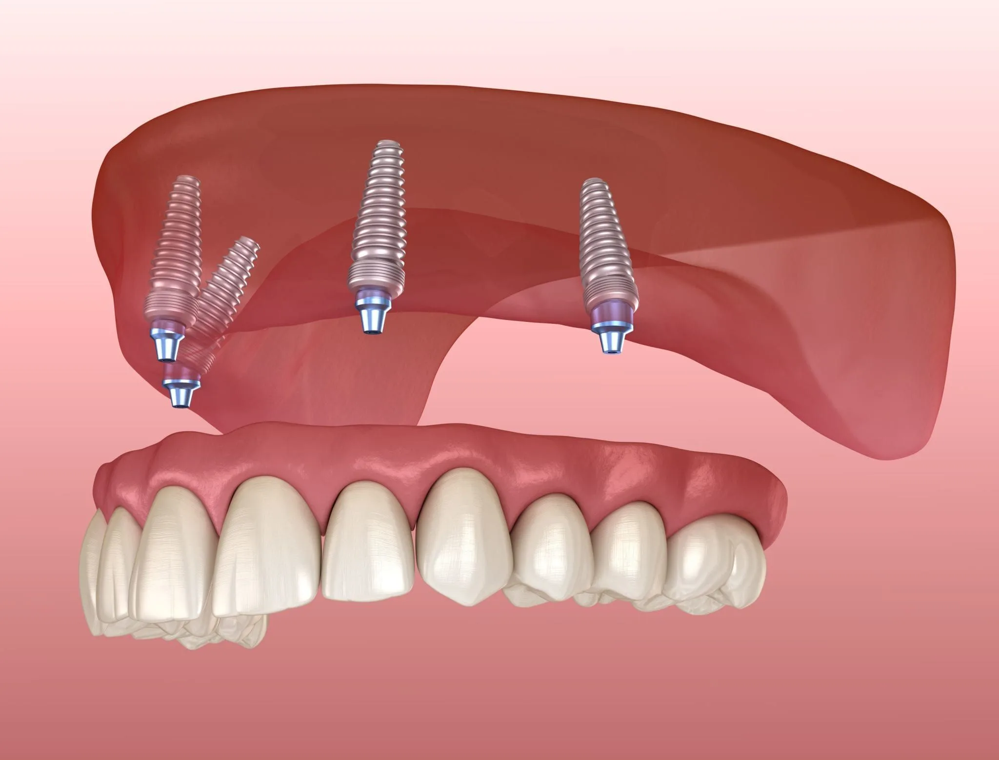 Cấy Implant hàm trên: kỹ thuật & lưu ý 2026