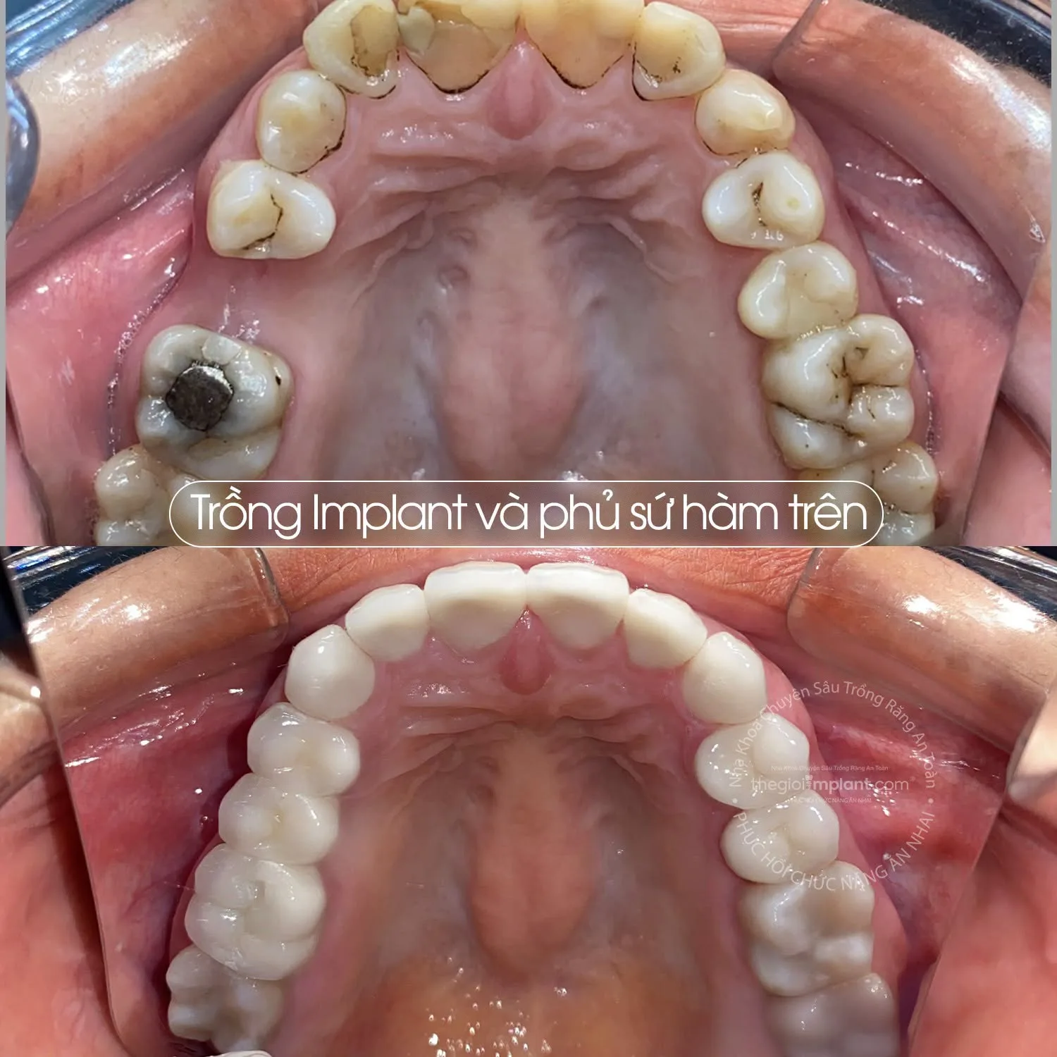 cấy implant hàm trên - hình 2