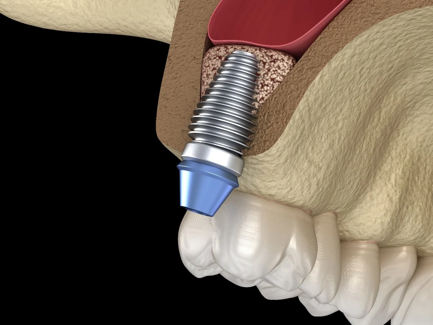 cấy implant hàm trên - hình 3