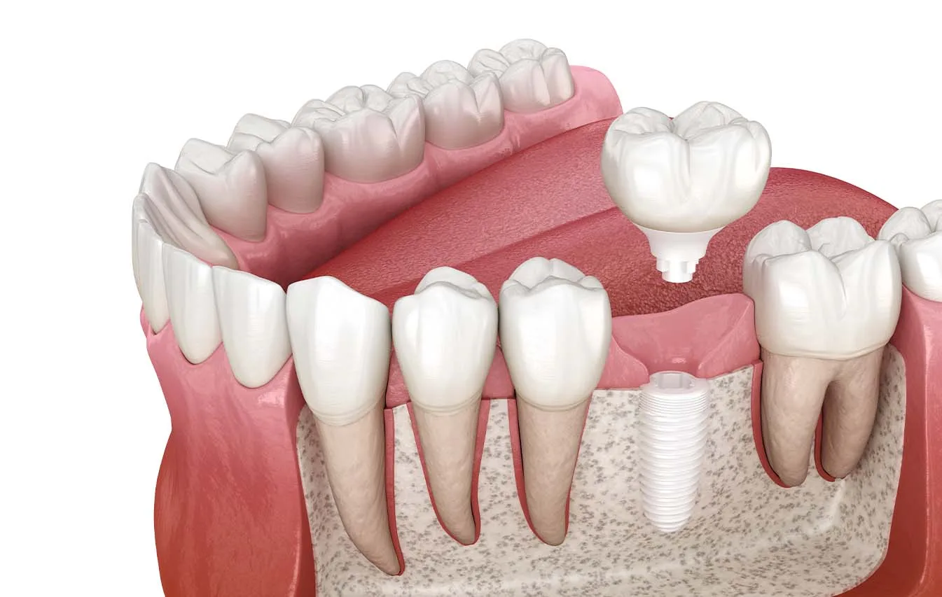 Ghép xương khối tự thân Implant: kỹ thuật 2026