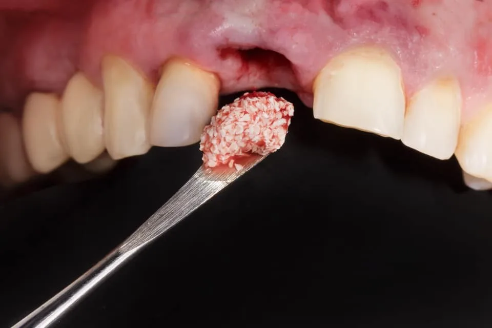 ghép xương khối tự thân - hình 2