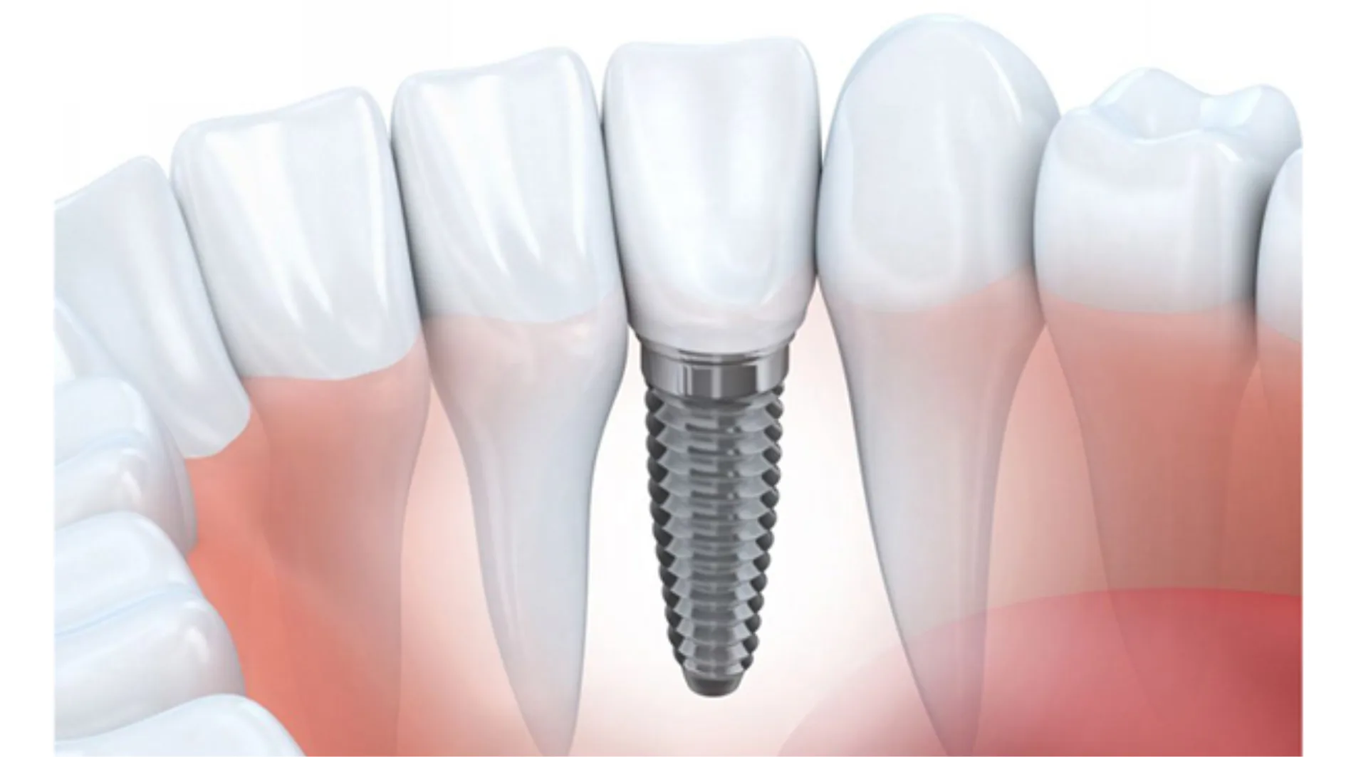 implant biotem - hình 3