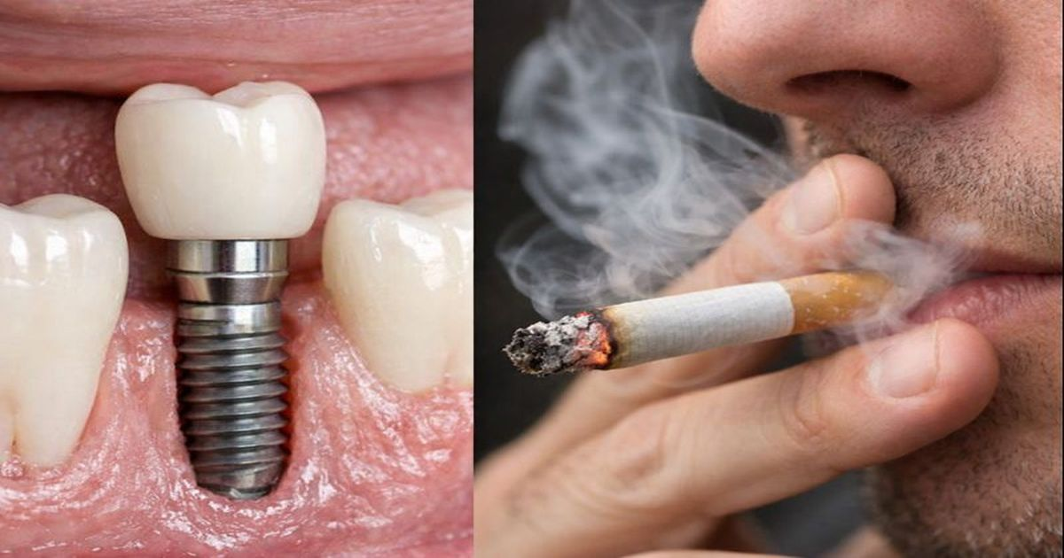 Implant cho người hút thuốc TPHCM 2026