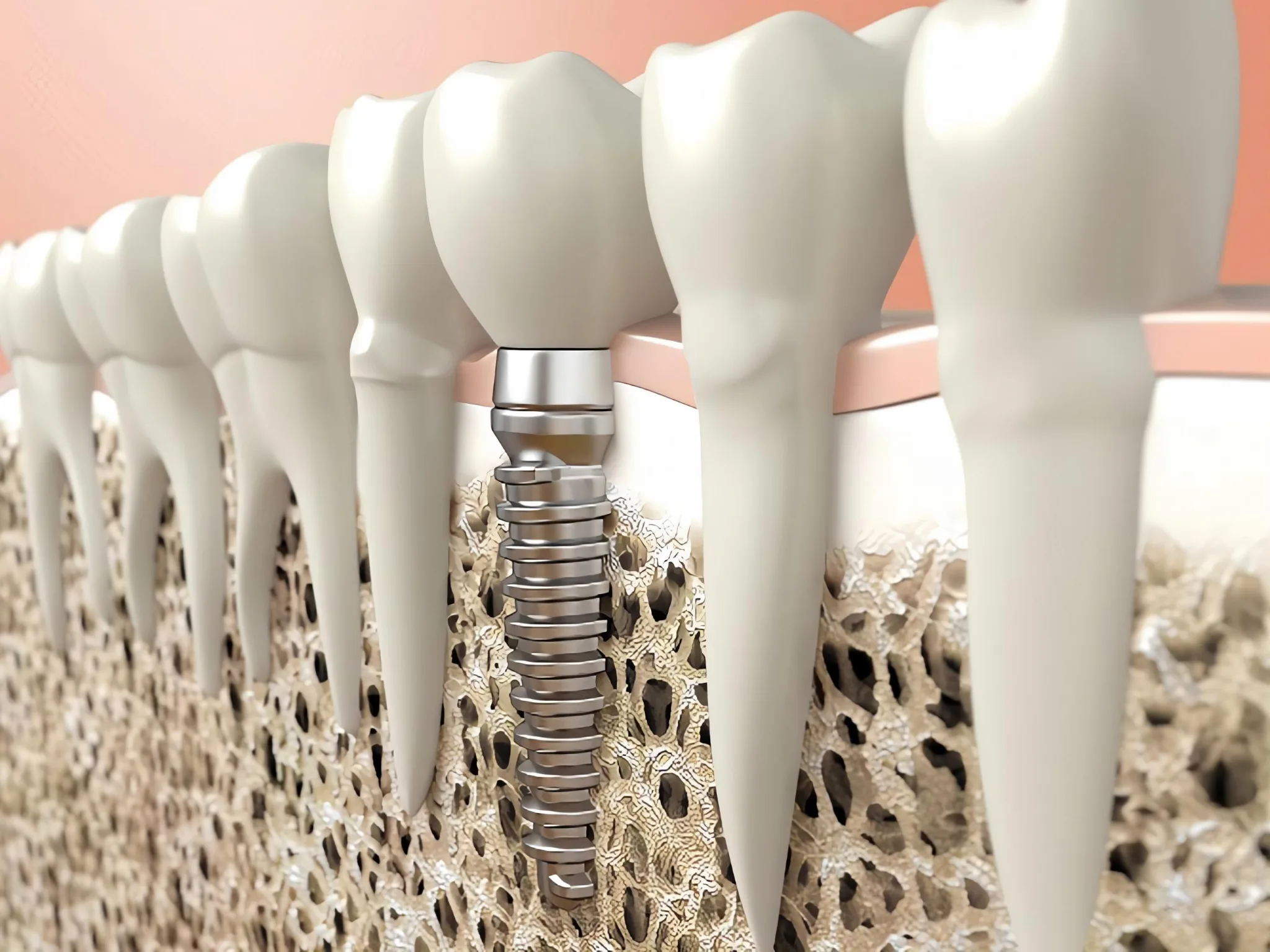 Implant cho người loãng xương: an toàn không 2026