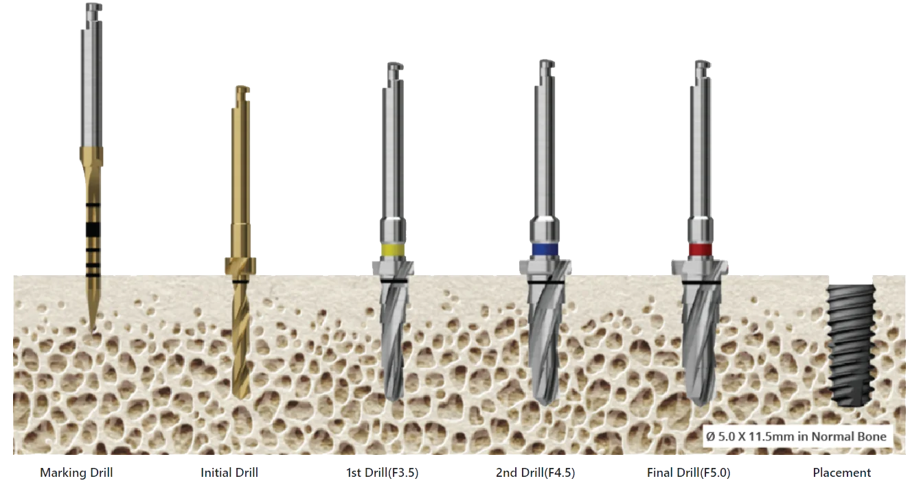 implant osstem ts3 - hình 3